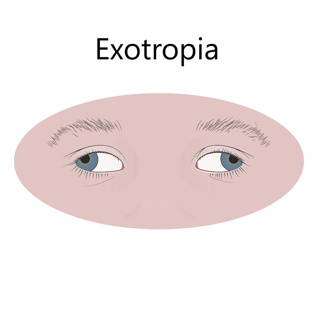 Childhood exotropia, illustration