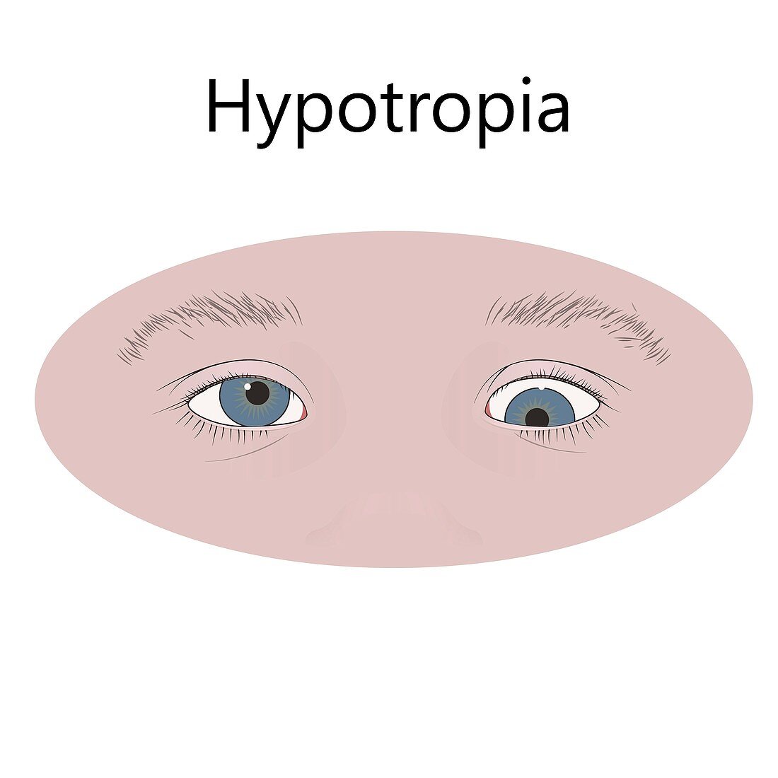 Childhood hypotropia, illustration