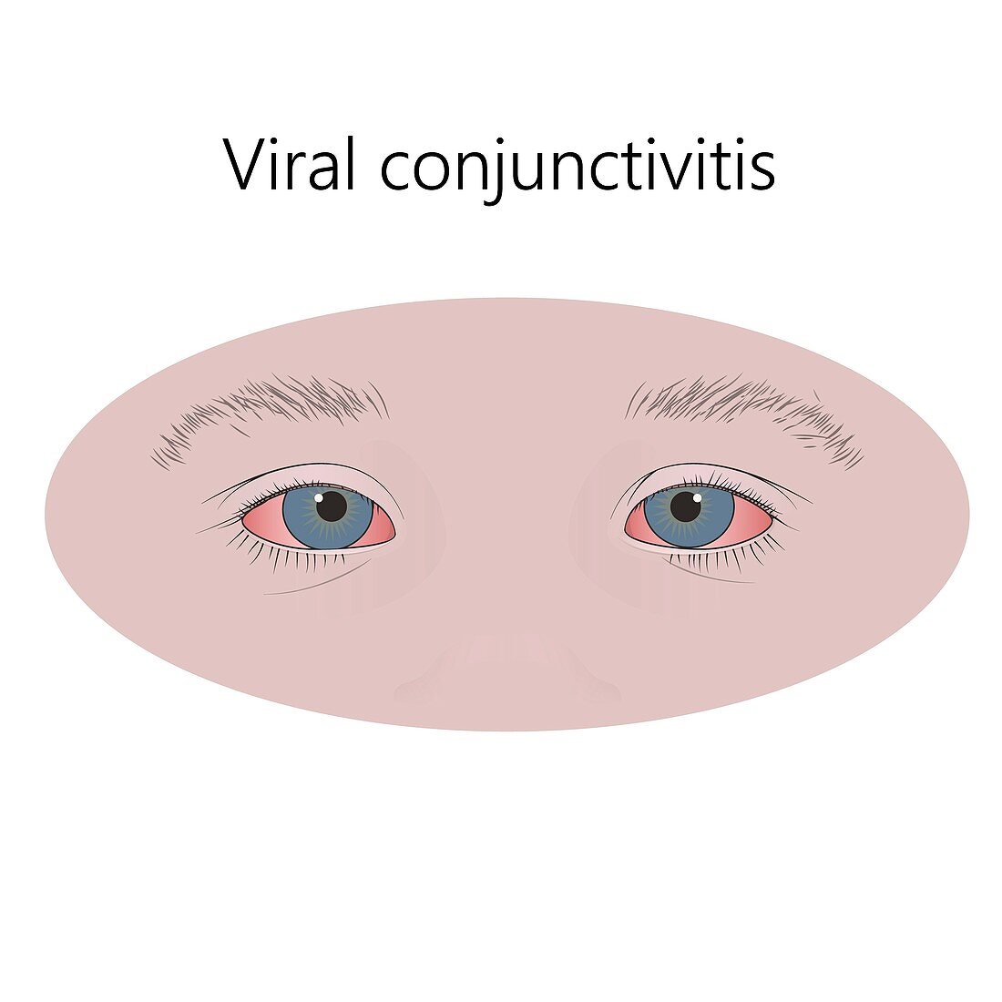 Viral conjunctivitis, illustration