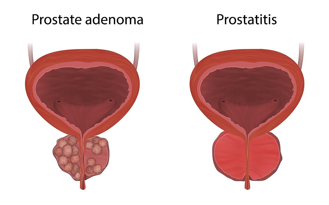 Prostate adenoma and prostatitis, illustration