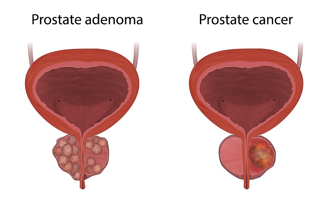 Prostate cancer and adenoma, illustration