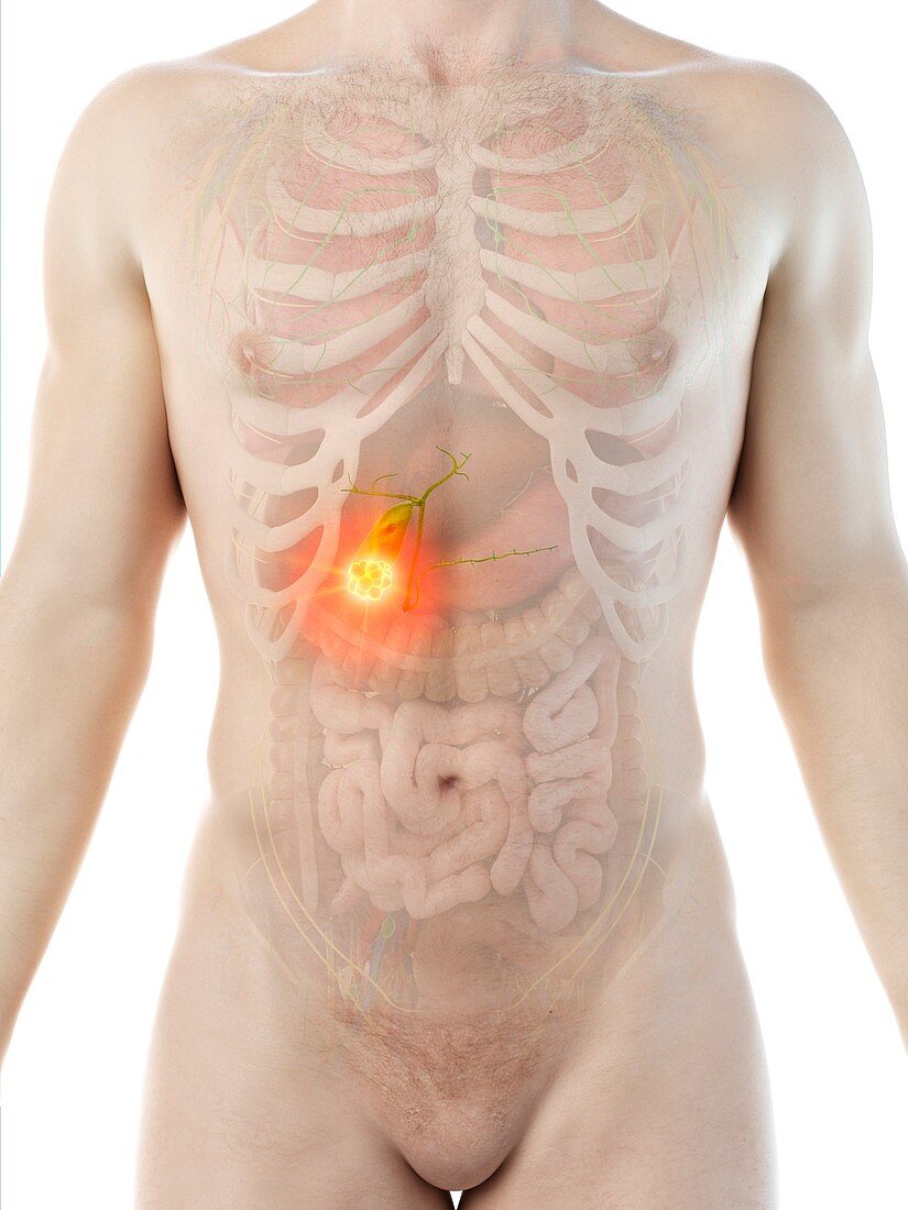 Gallbladder cancer, conceptual illustration