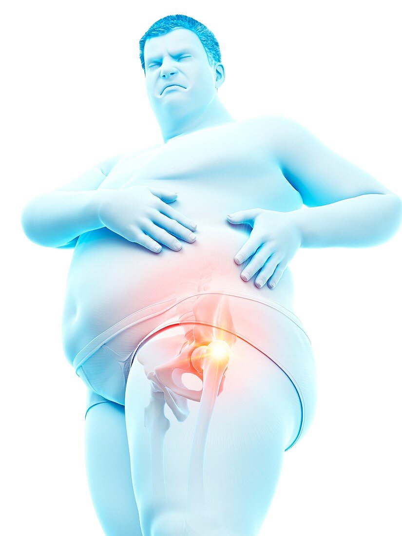 Obese man with hip pain, illustration