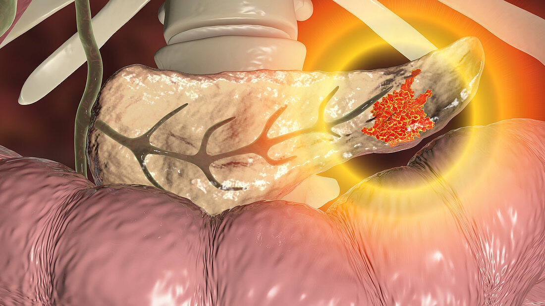 Pancreatic cancer, illustration