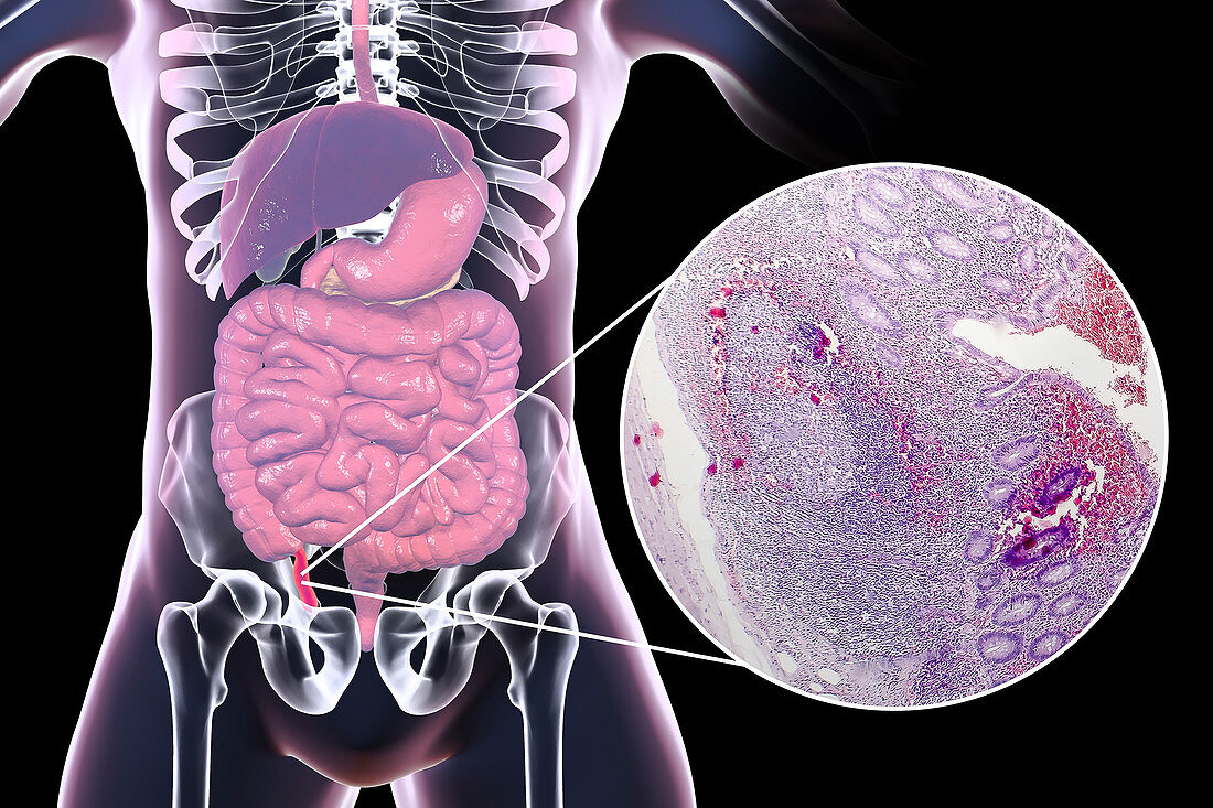 Chronic appendicitis, illustration and light micrograph