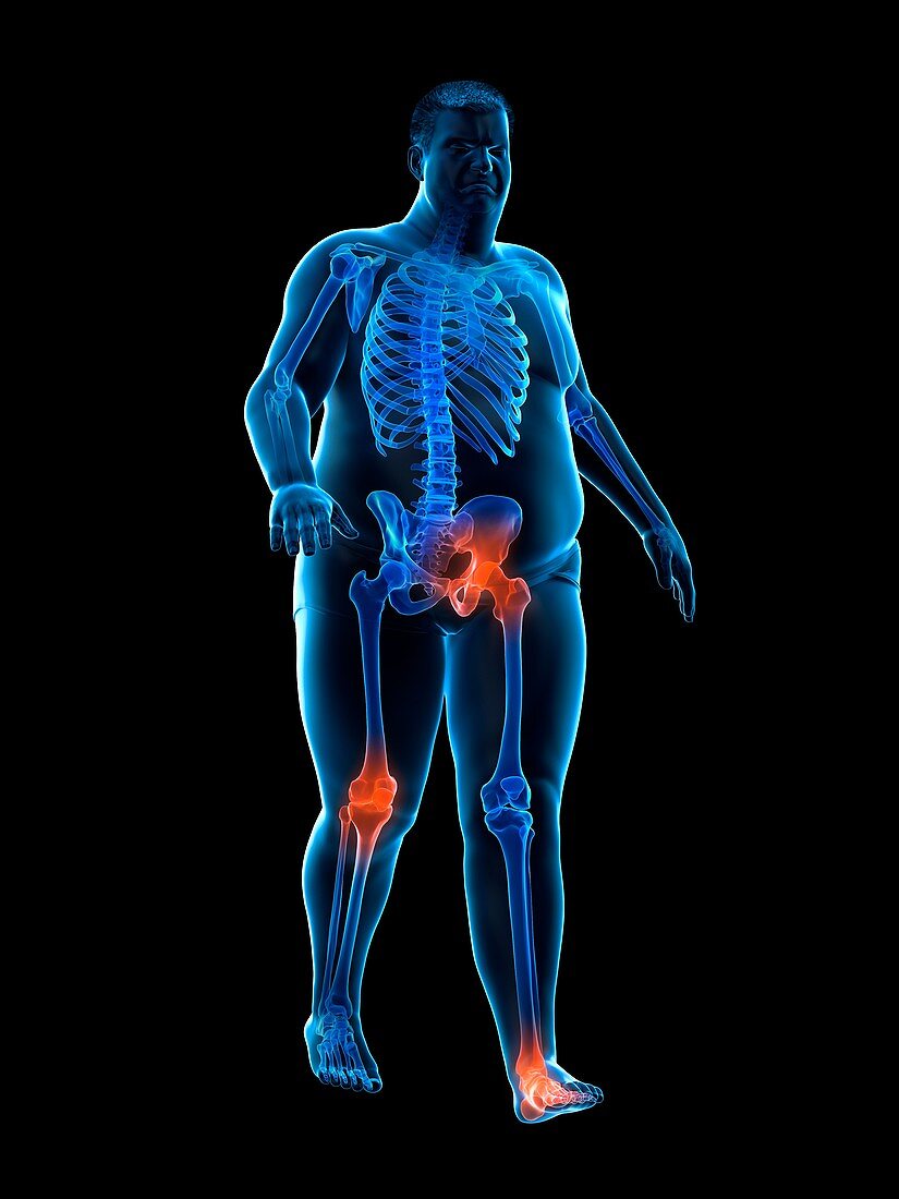 Obese runner with joint pain, illustration