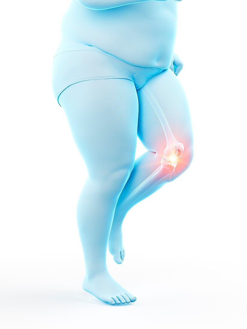 Obese runner with knee pain, illustration