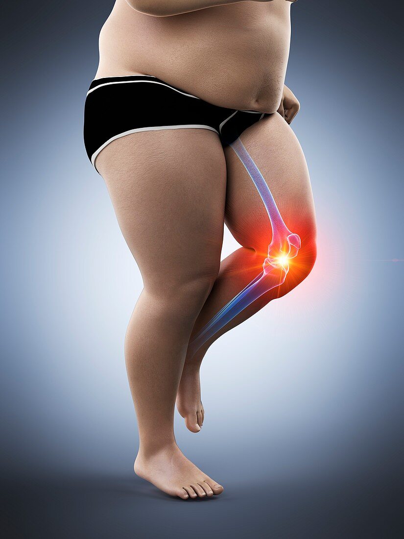 Obese runner with knee pain, illustration