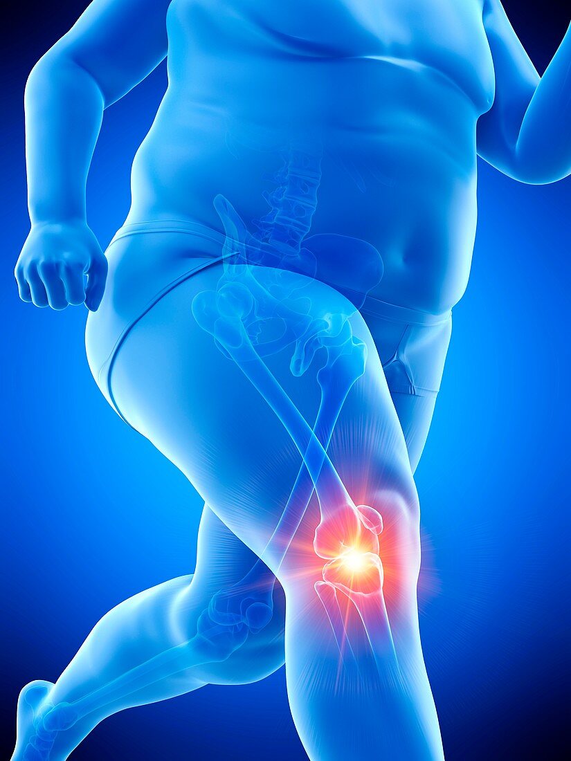 Obese runner with knee pain, illustration