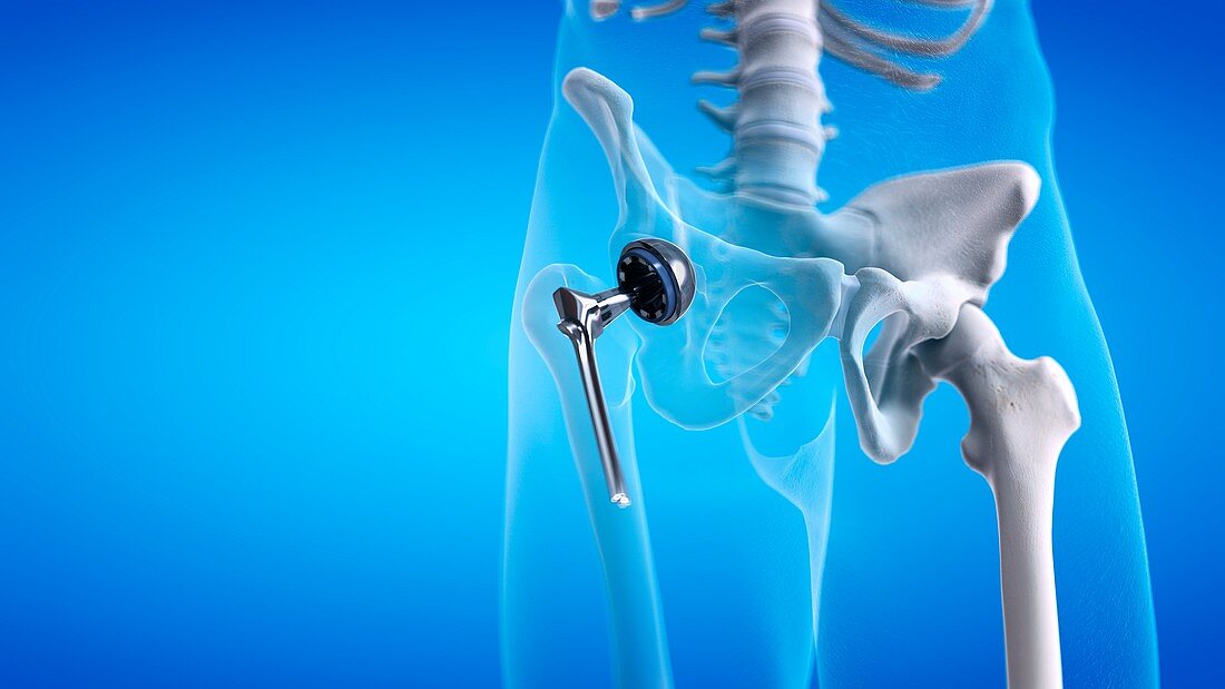 Hip replacement, illustration