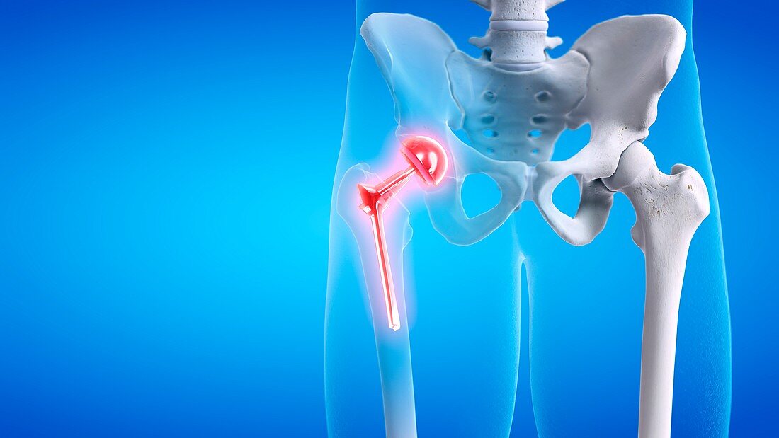 Painful hip replacement, conceptual illustration