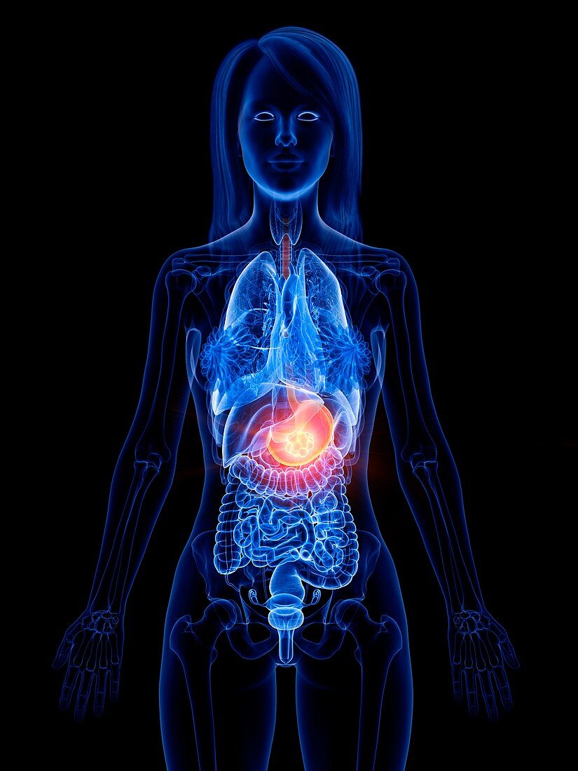 Stomach cancer, conceptual illustration