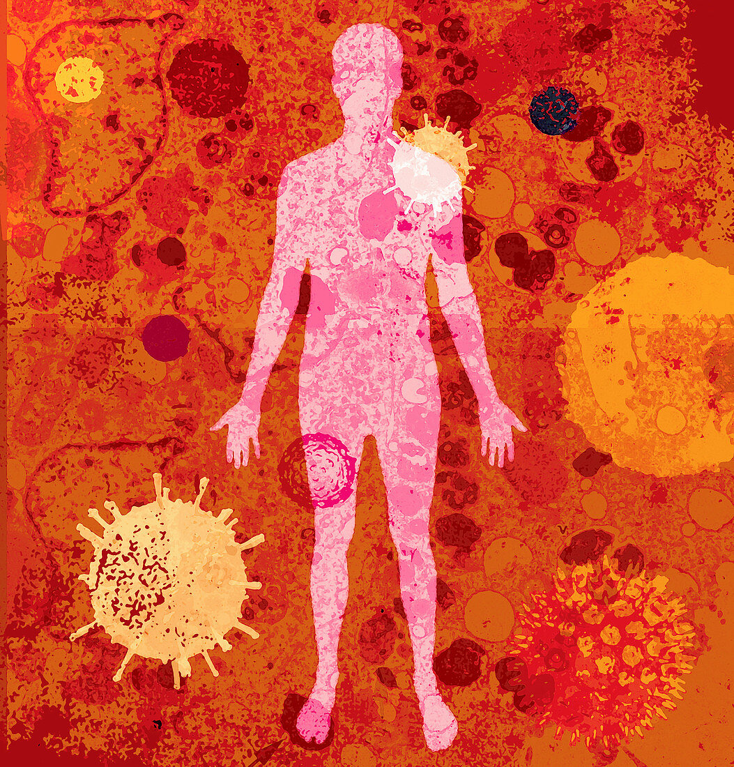 The human body with lots of different viruses, illustration