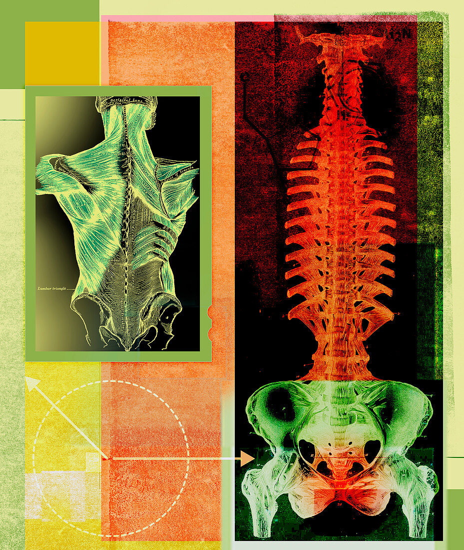 X-ray of inflamed spine and pelvis, illustration