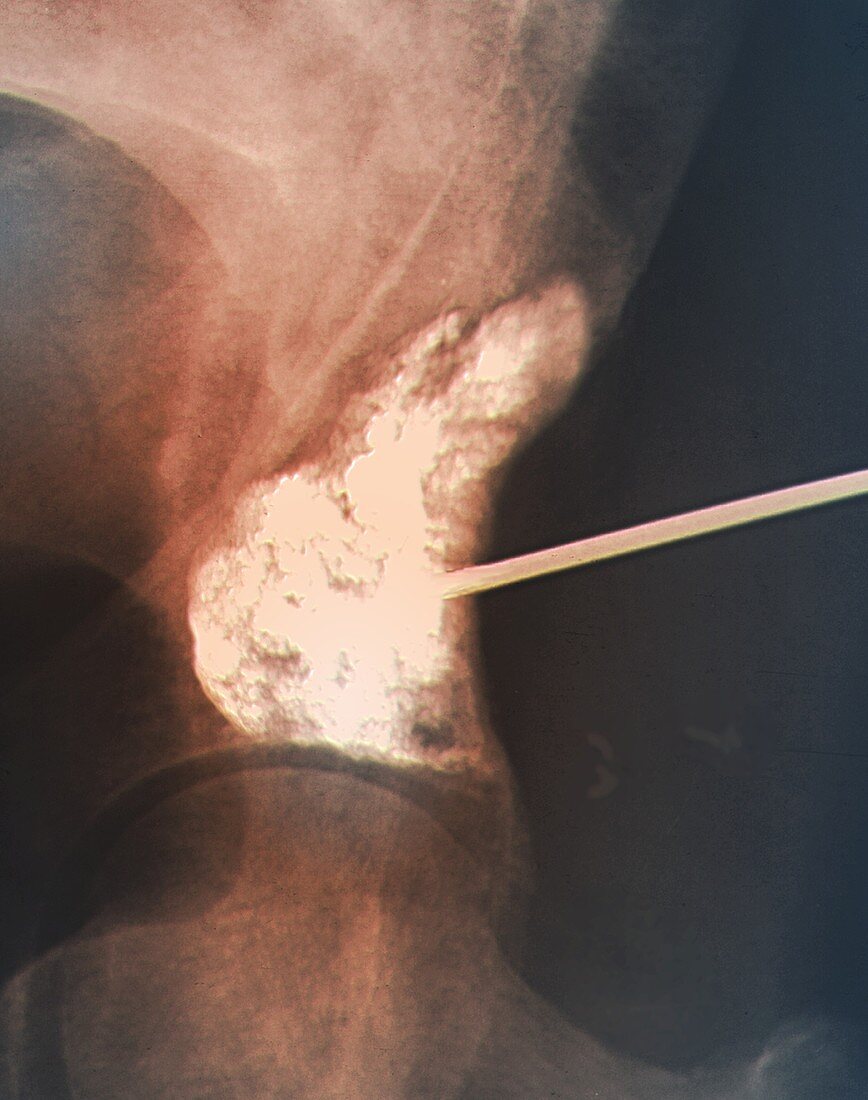 Bone augmentation in metastatic cancer, X-ray