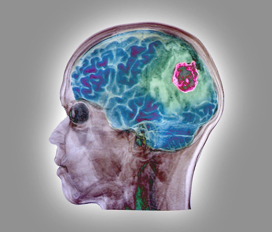 Brain tumour, 3D MRI