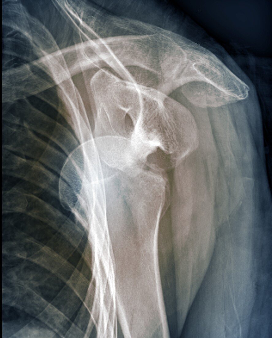 Dislocated shoulder, X-ray