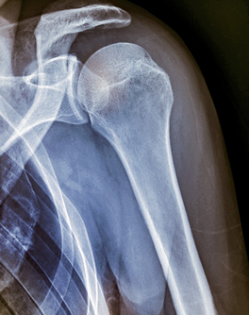 Dislocated shoulder, X-ray