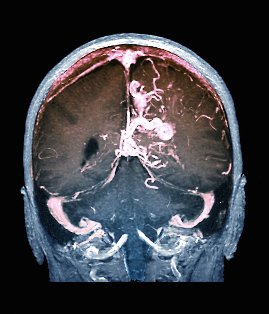 Cerebral arteriovenous malformation, MRA scan