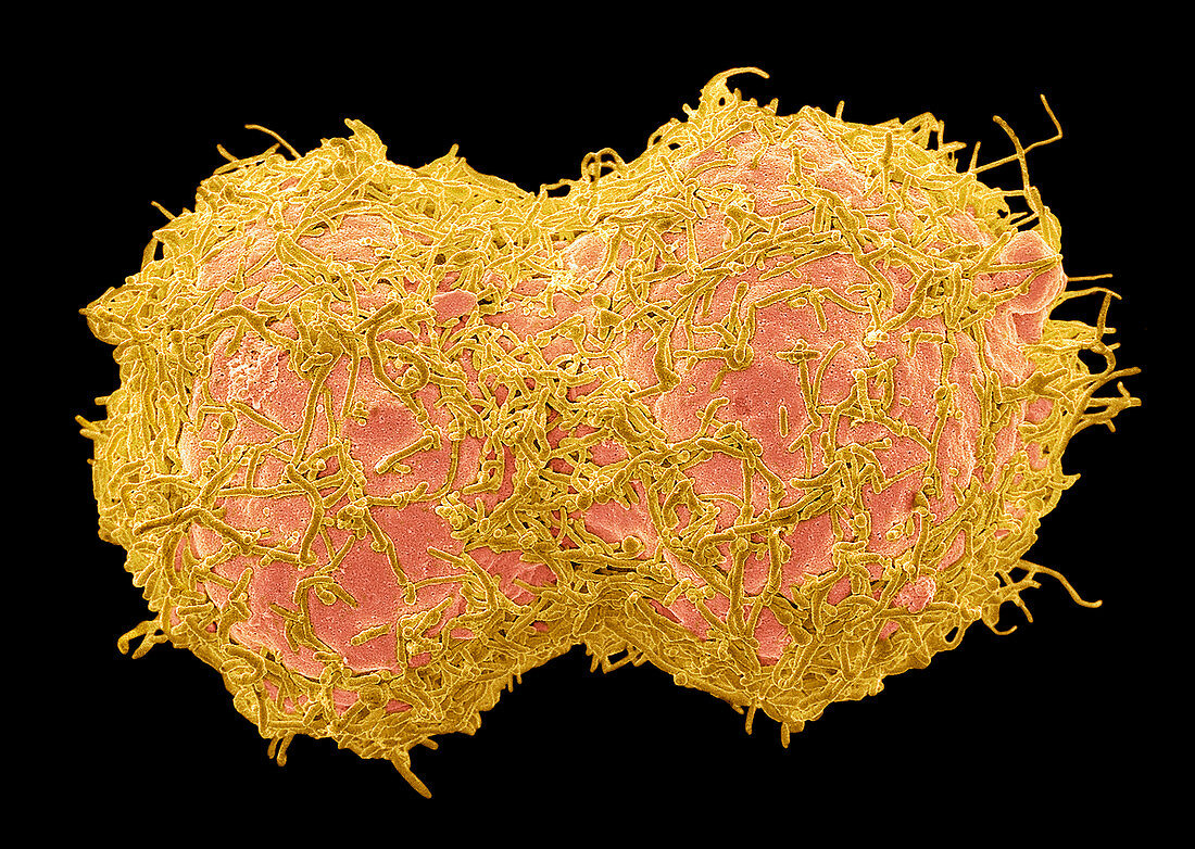 Dividing breast cancer cells, SEM