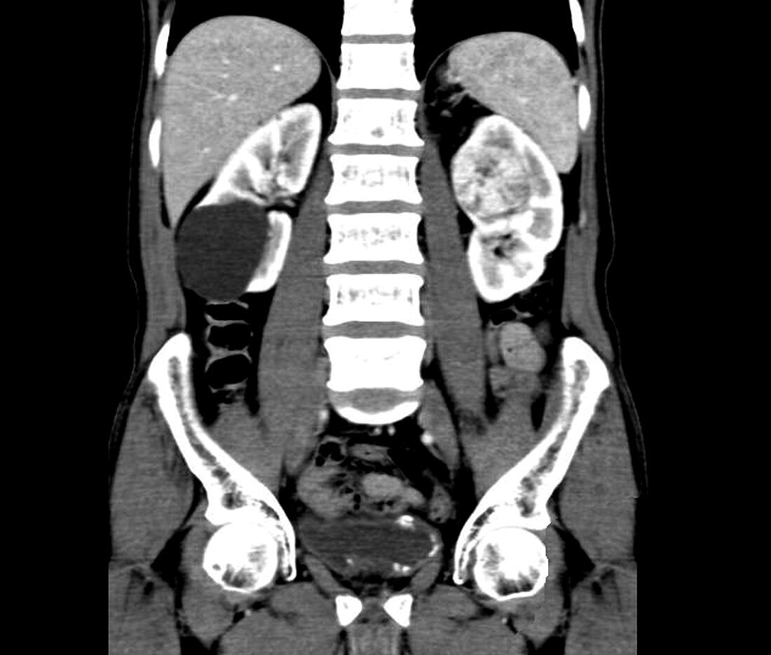 Renal cancer, CT scan