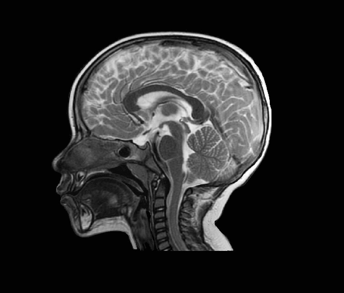 Child's head and brain, MRI scan