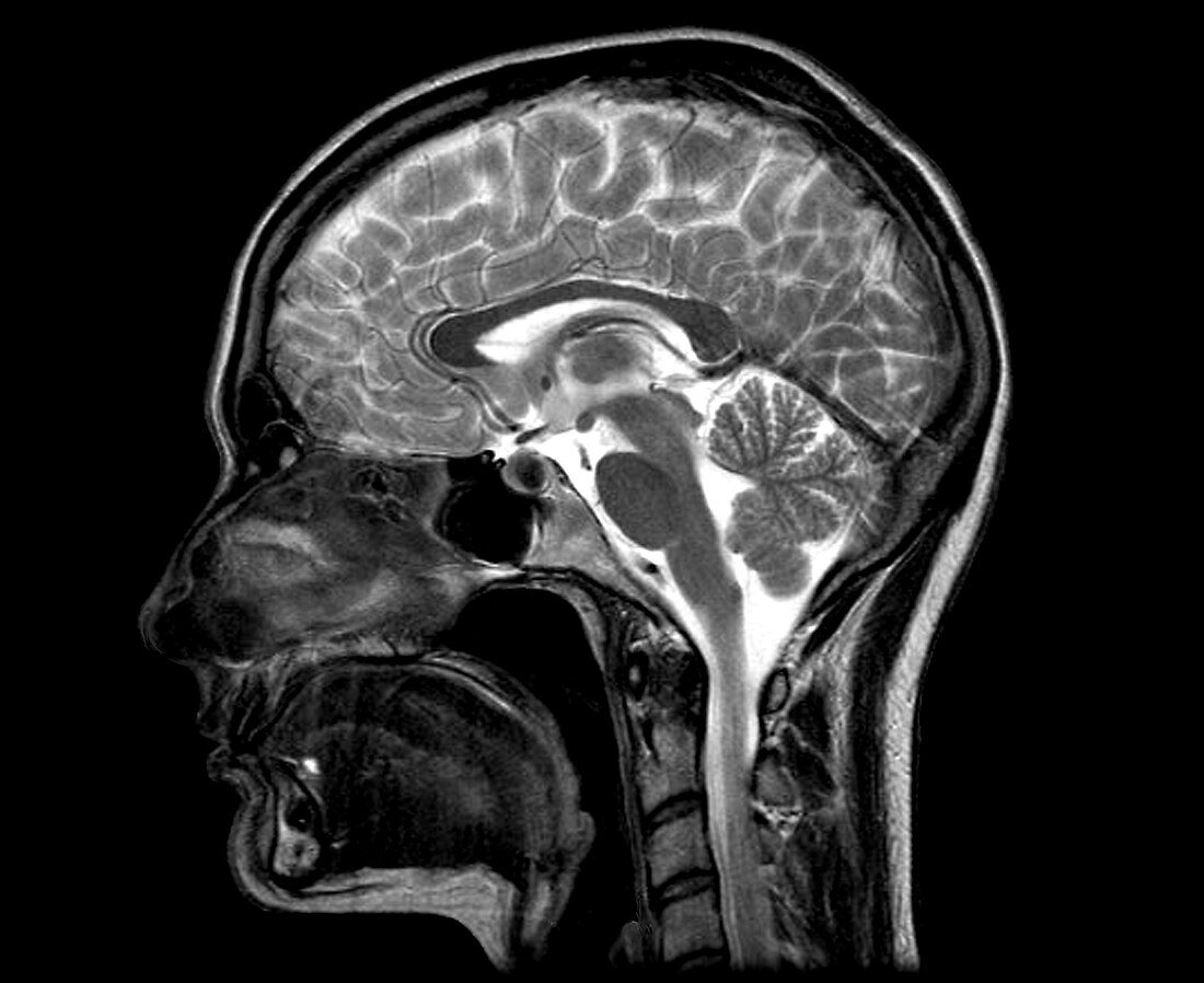 Human head and brain, MRI scan