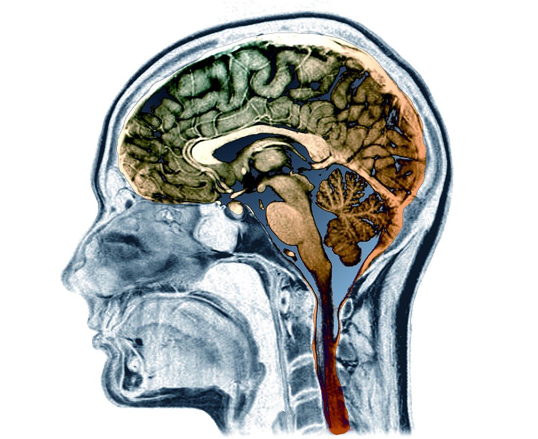 Human head and brain, MRI scan