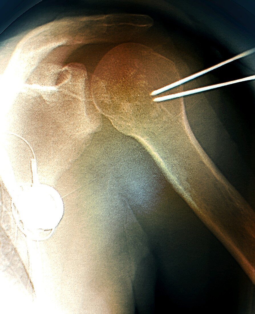 Shoulder cementoplasty, X-ray