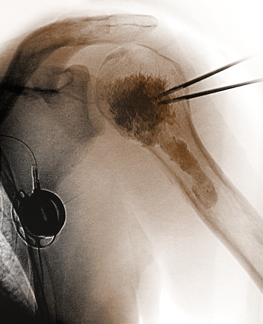 Shoulder cementoplasty, X-ray