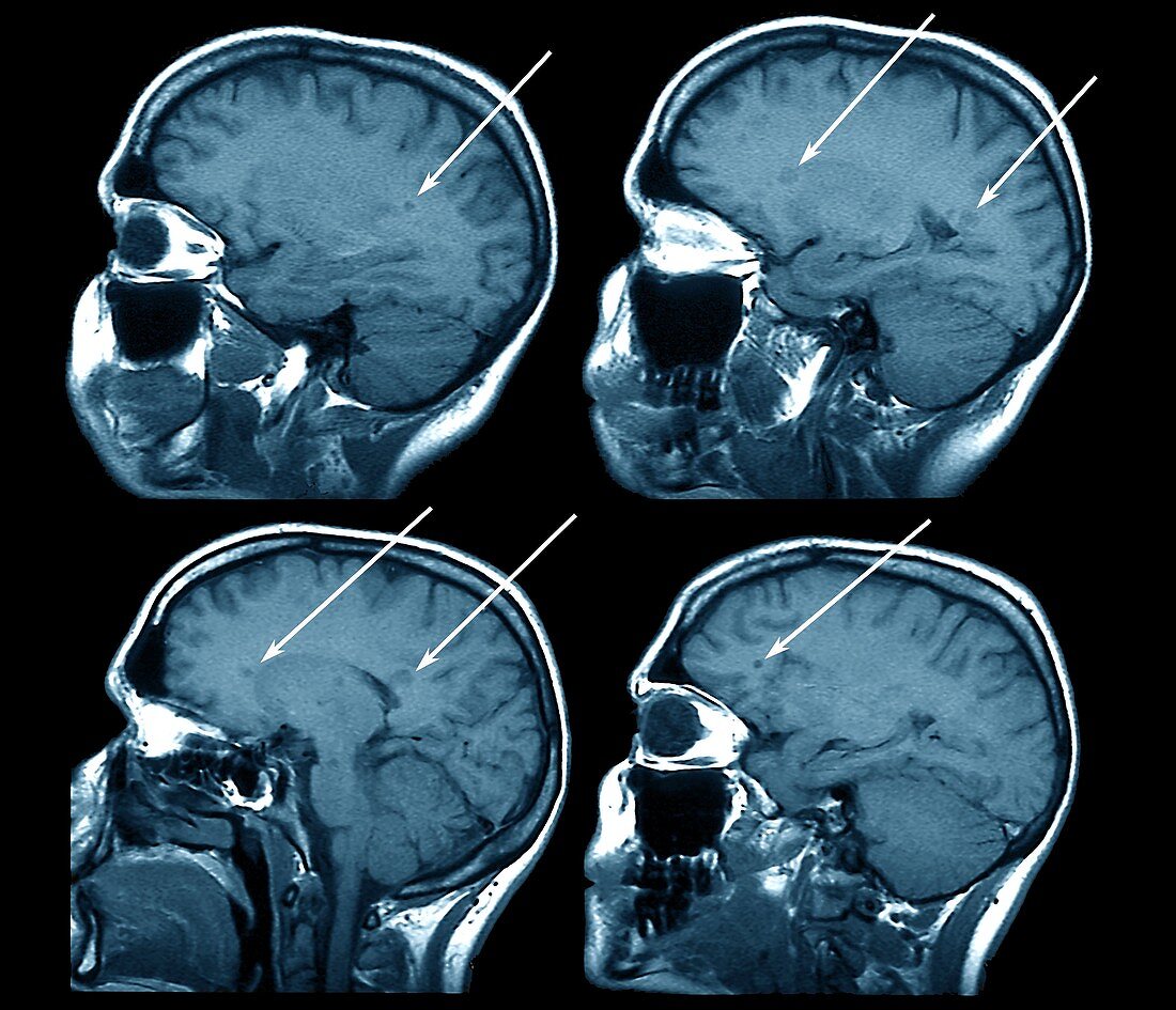 Multiple sclerosis, MRI scans