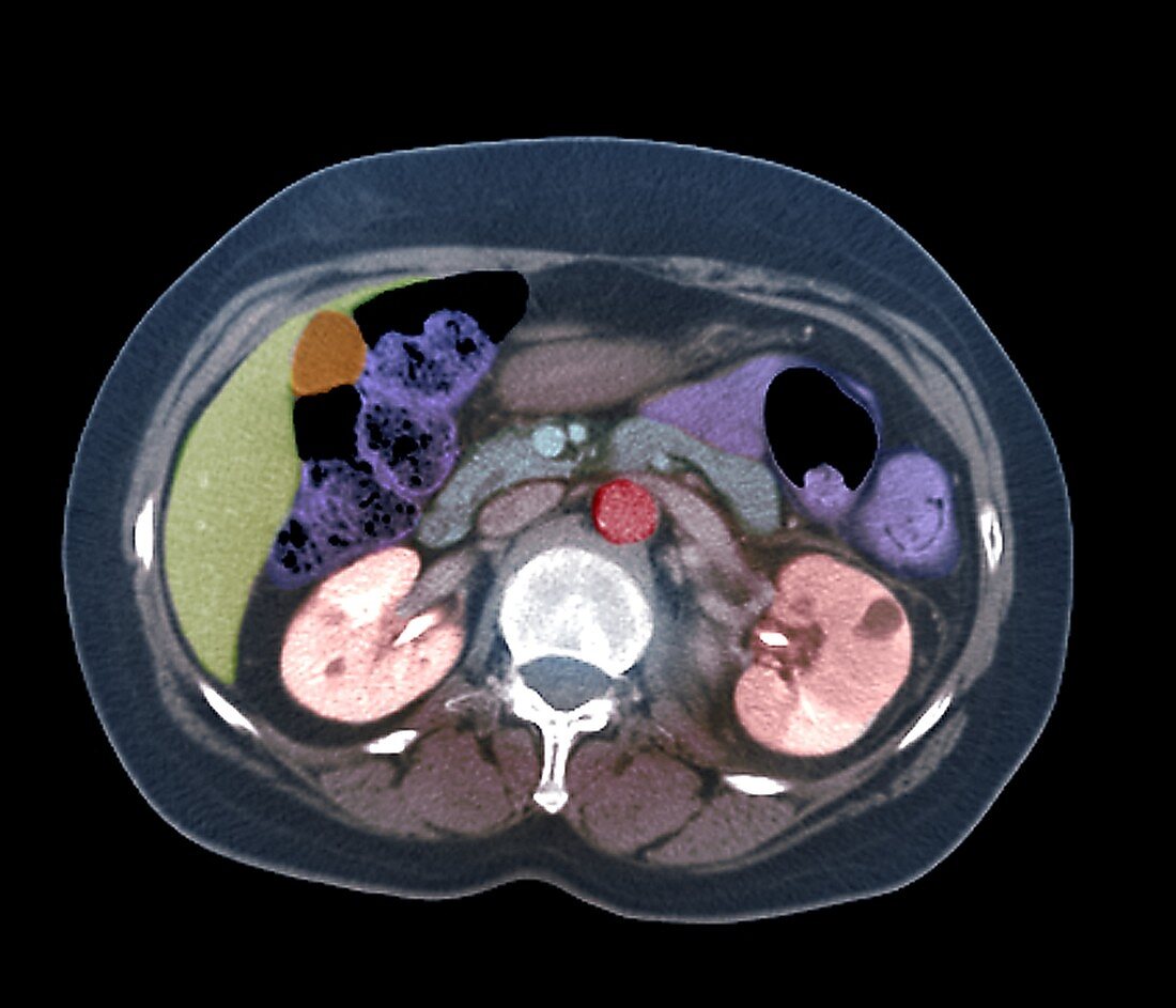 Pyelonephritis, axial CT scan