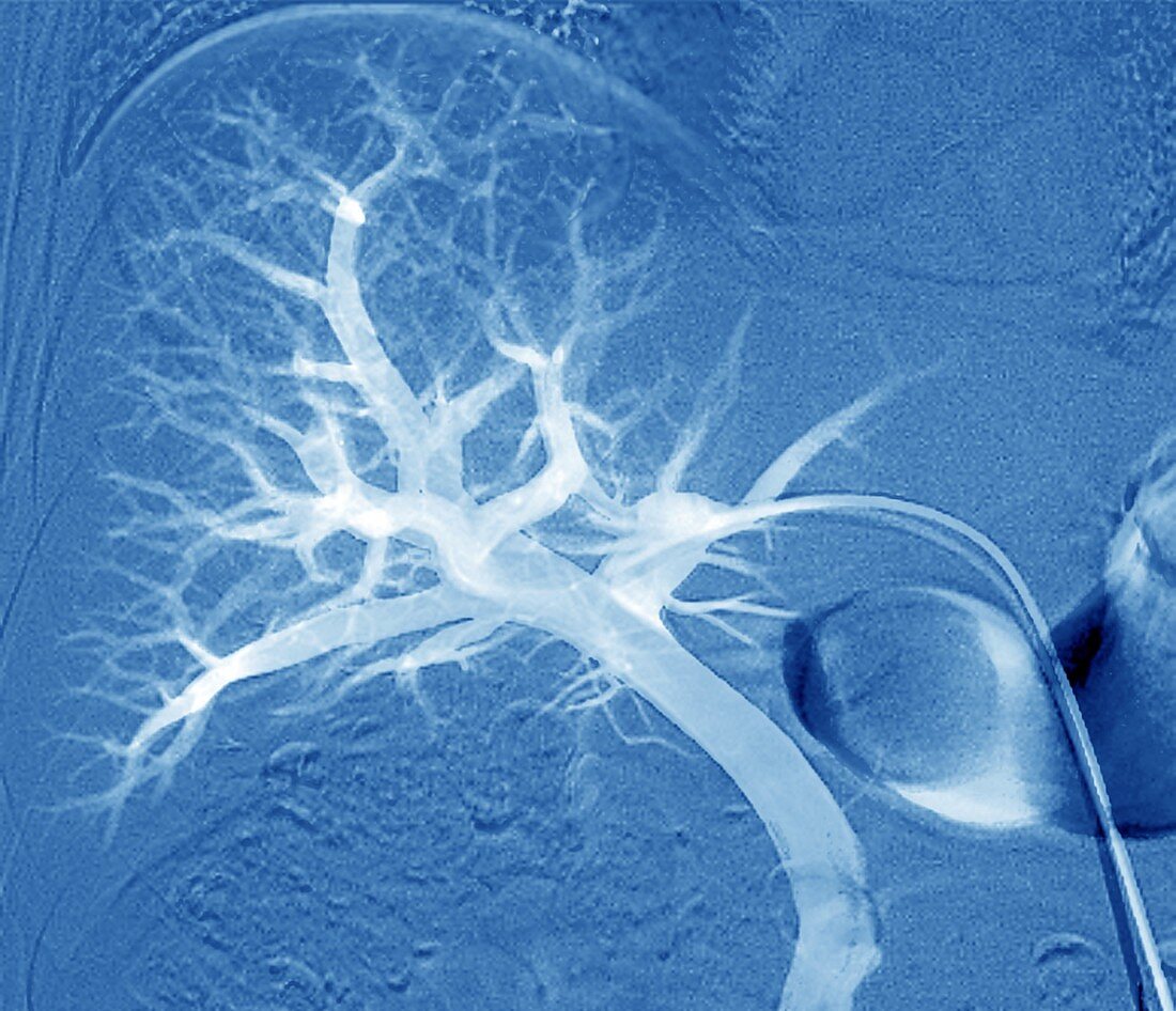 Liver blood vessels, angiogram