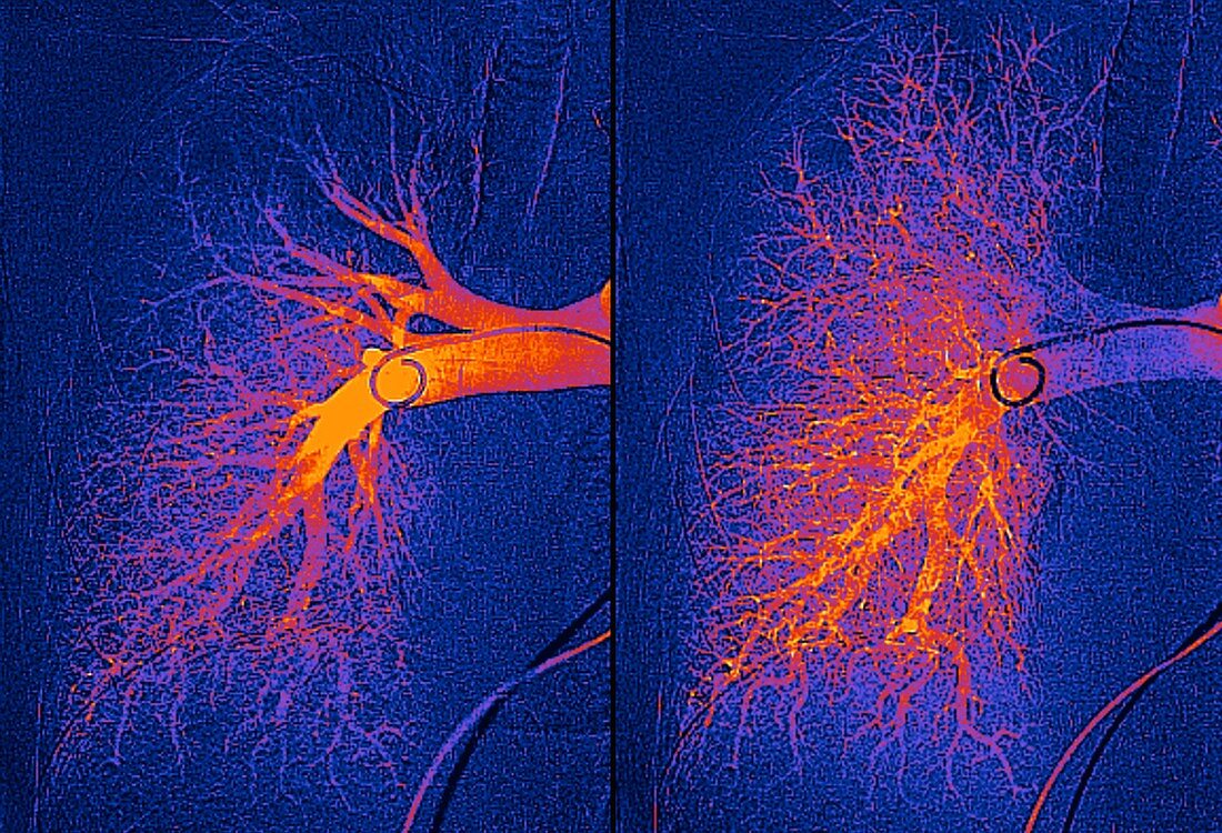 Lung blood vessels, angiograms