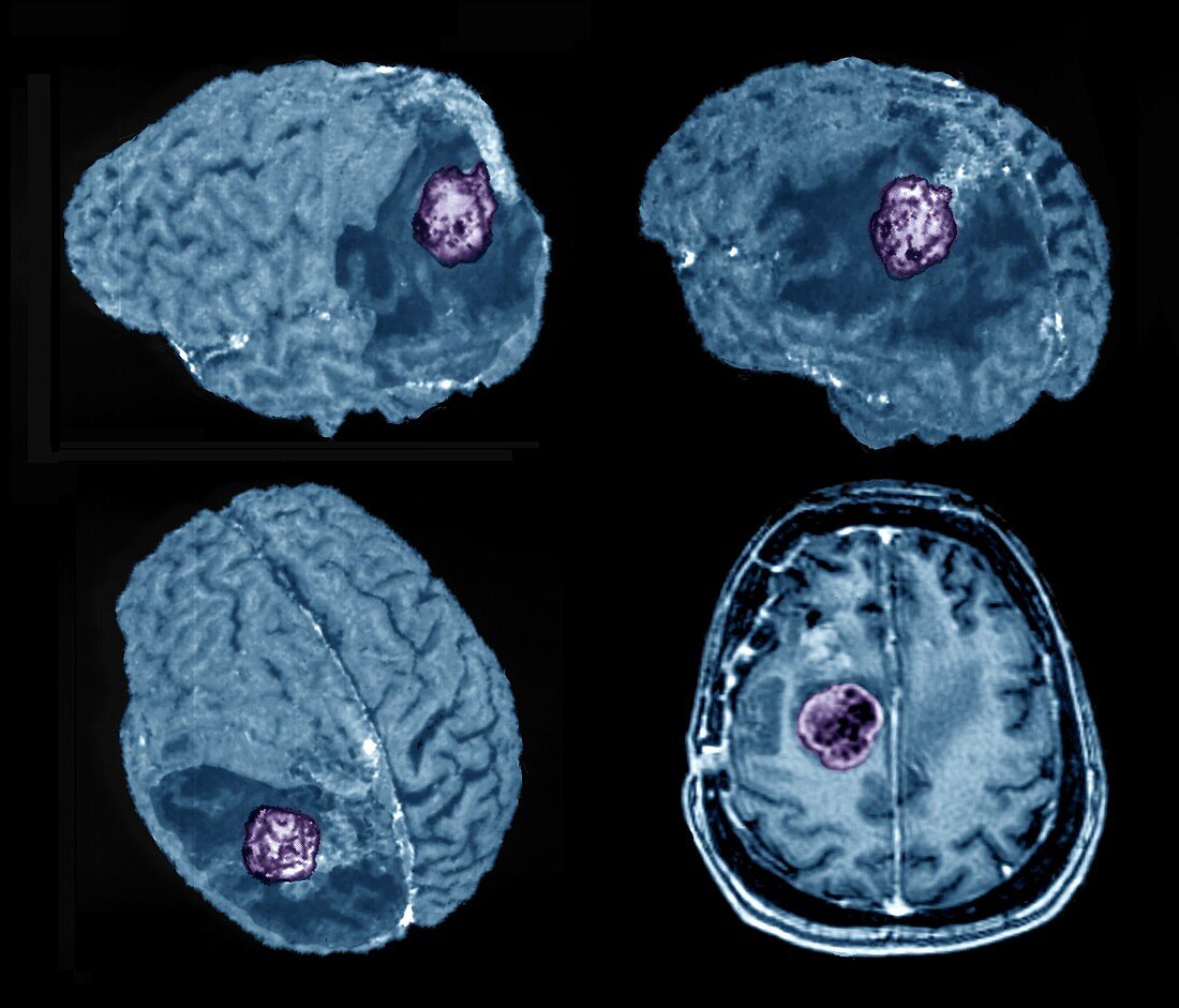 Recurrent glioma brain tumour, 3D and 2D MRI scans