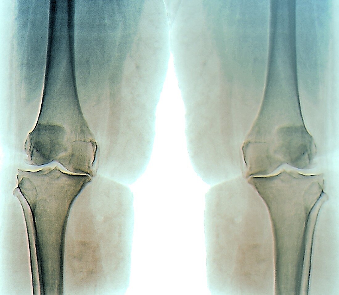 Knee osteoarthritis in obesity, X-ray