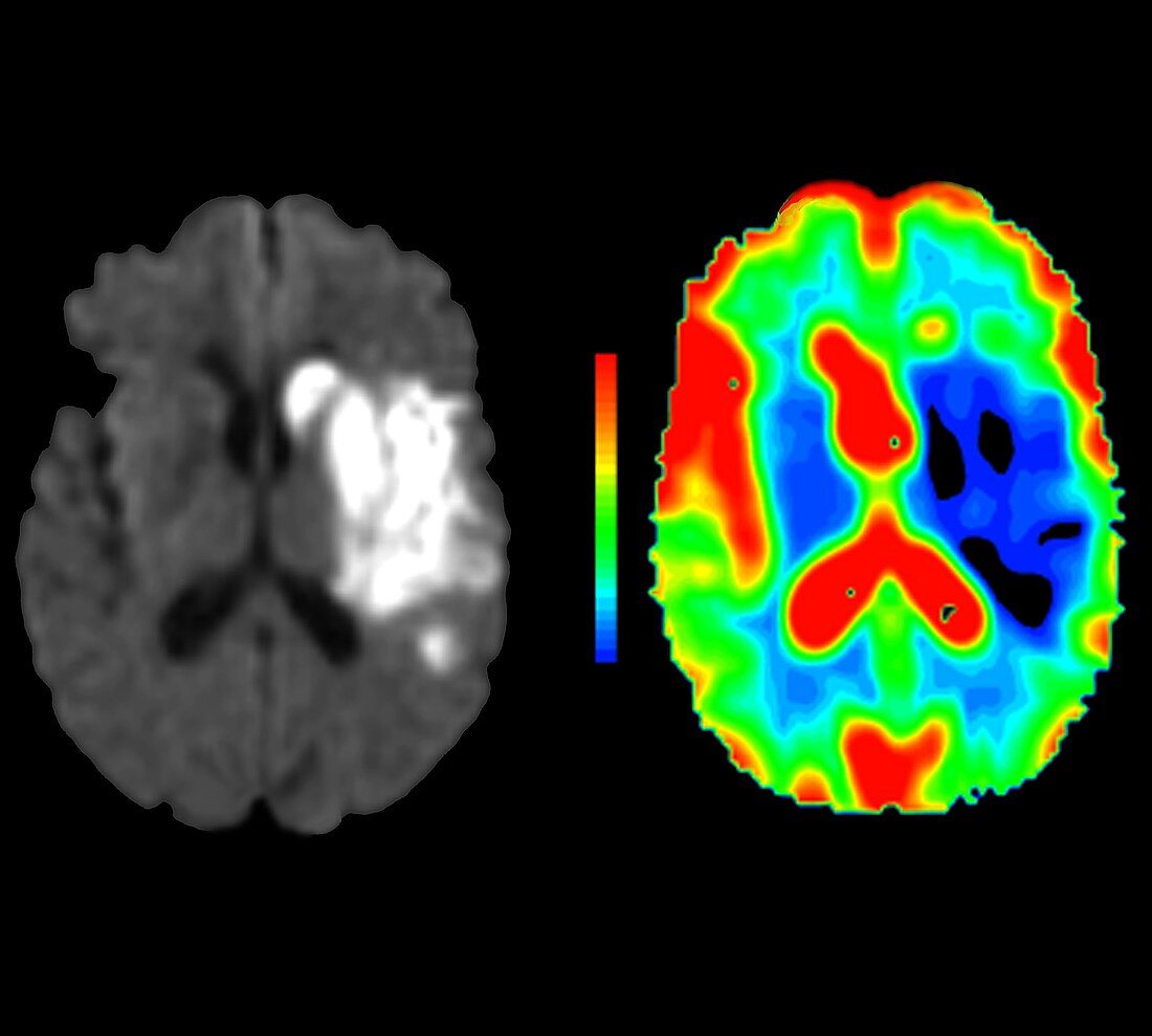 Brain damage due to a stroke, MRI scans