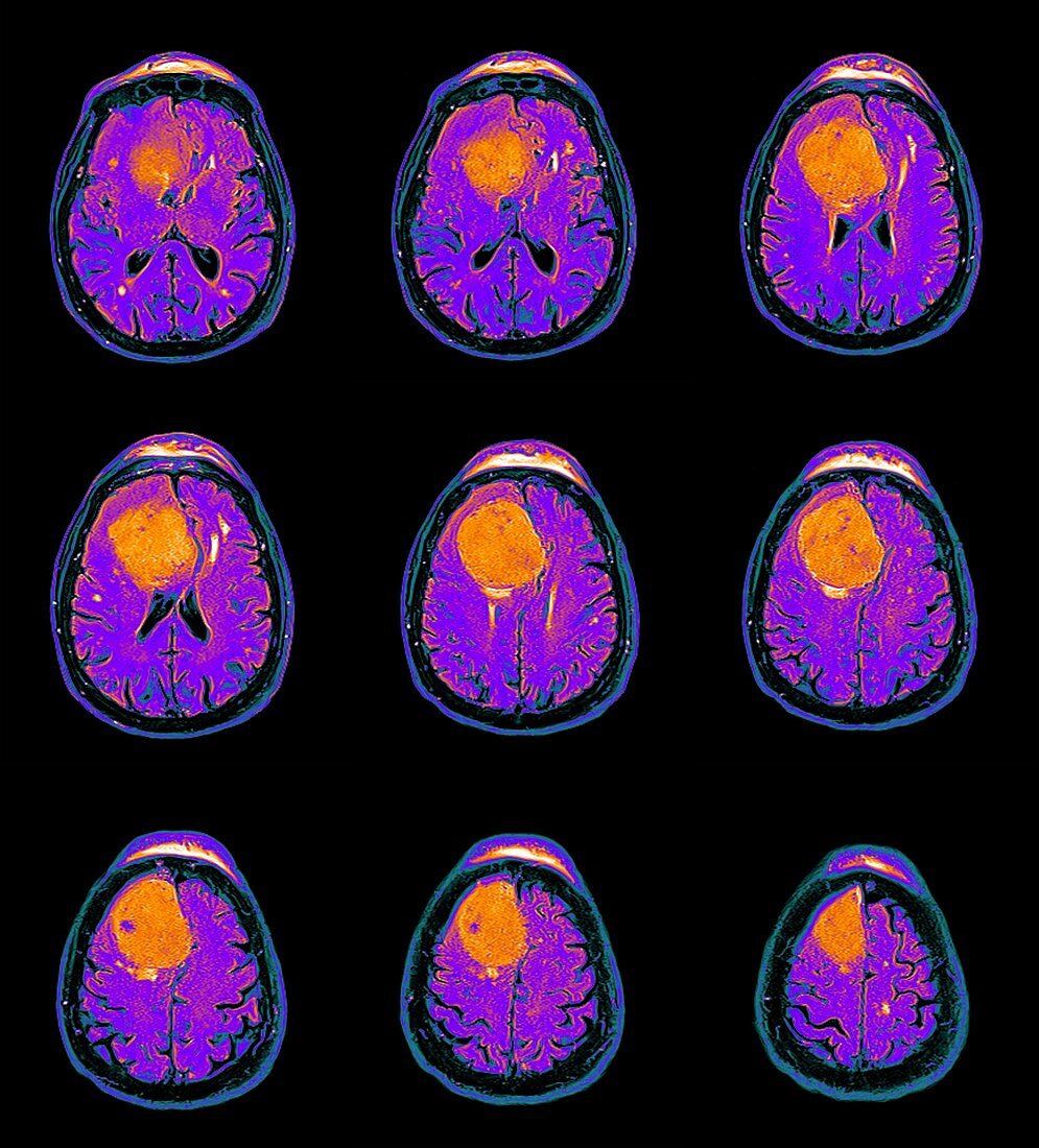Meningioma brain cancer, MRI scans