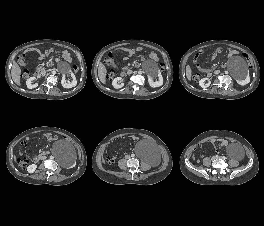 Kidney cyst, axial CT scans