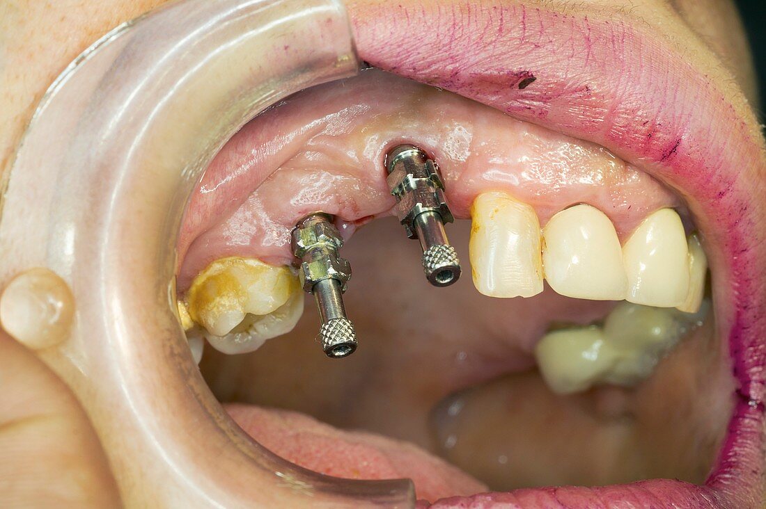 Dental bridge preparation