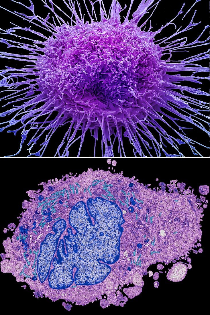 Lung cancer SEM-TEM comparison