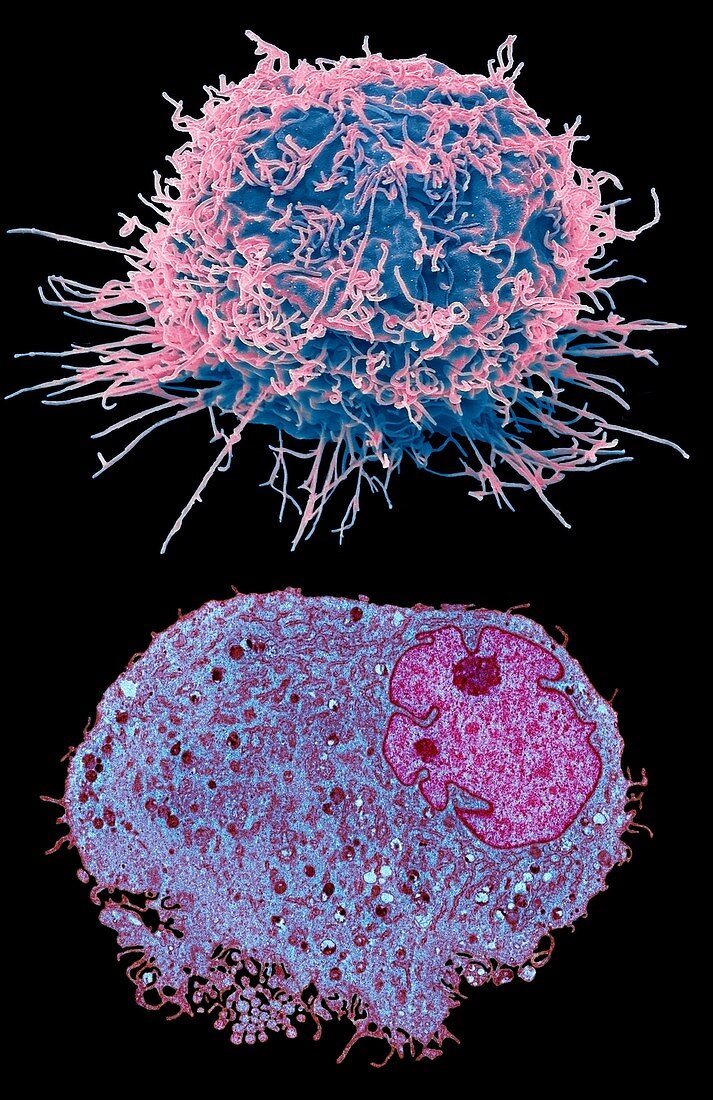 Leukaemia cell, SEM-TEM comparison