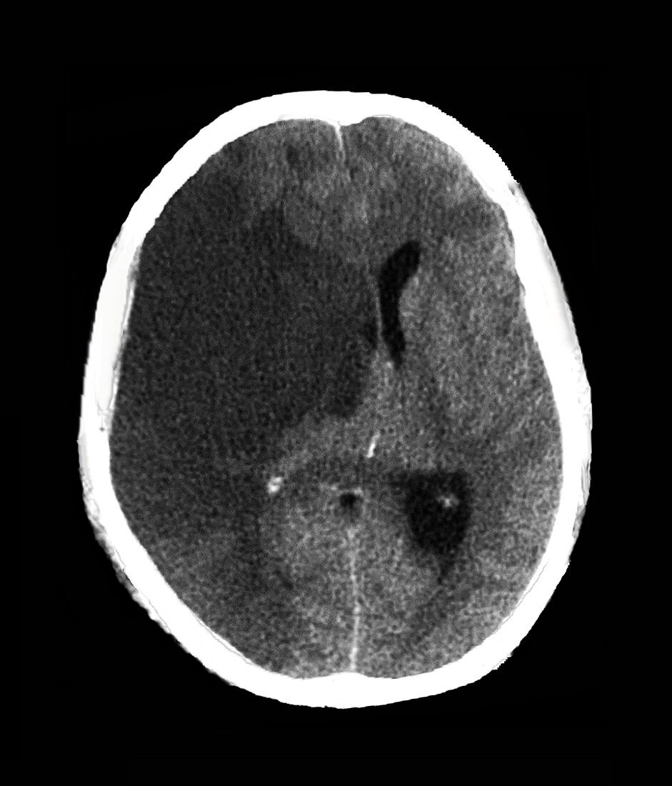 Stroke and brain damage, CT scan