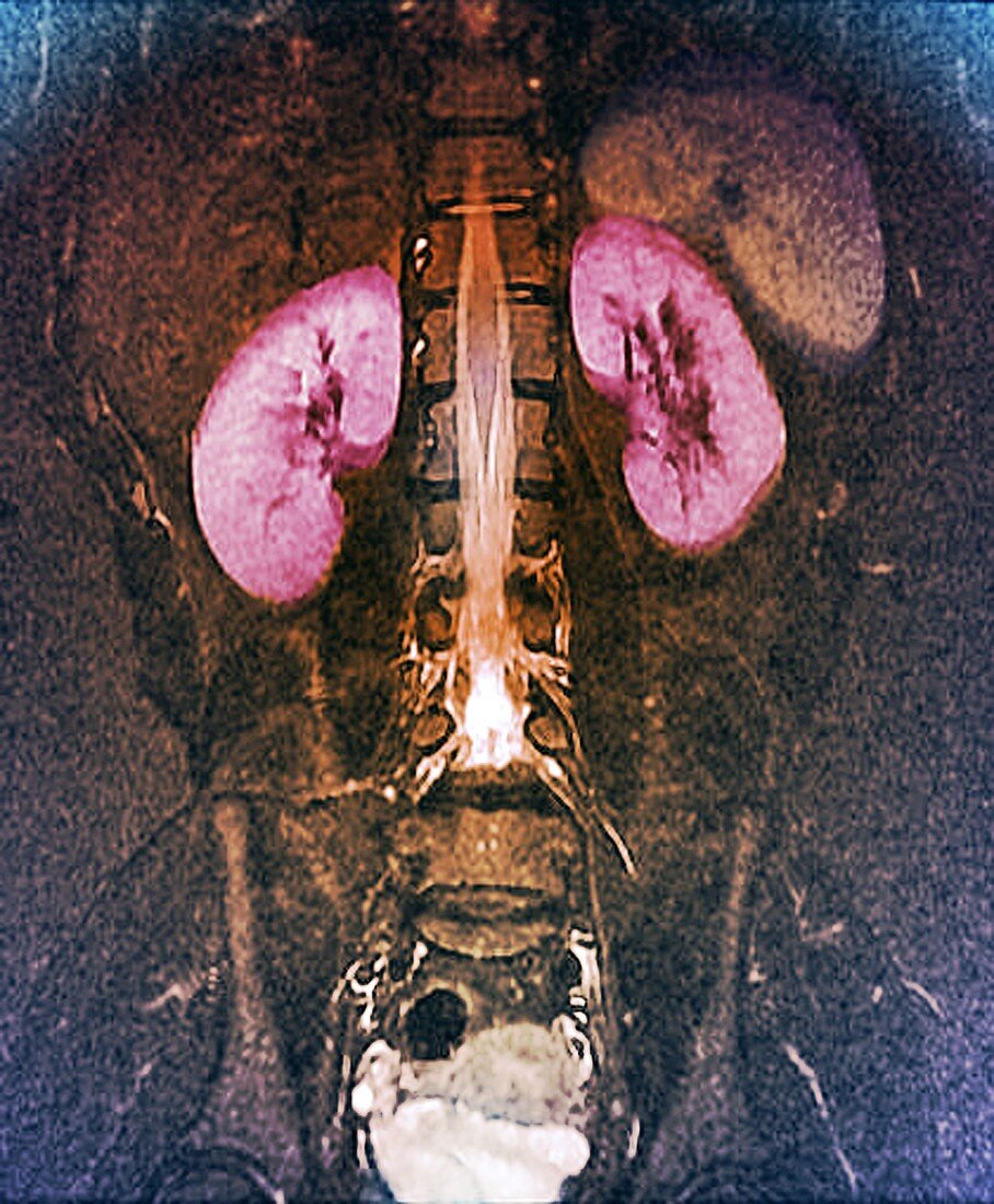 Kidneys and lumbar spinal cord, MRI scan