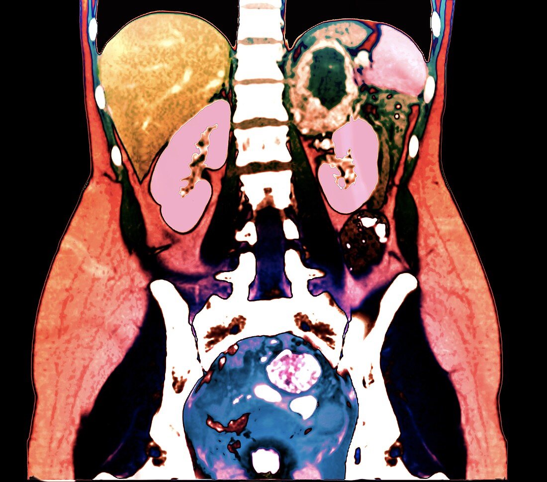 Adrenal gland cancer, CT scan