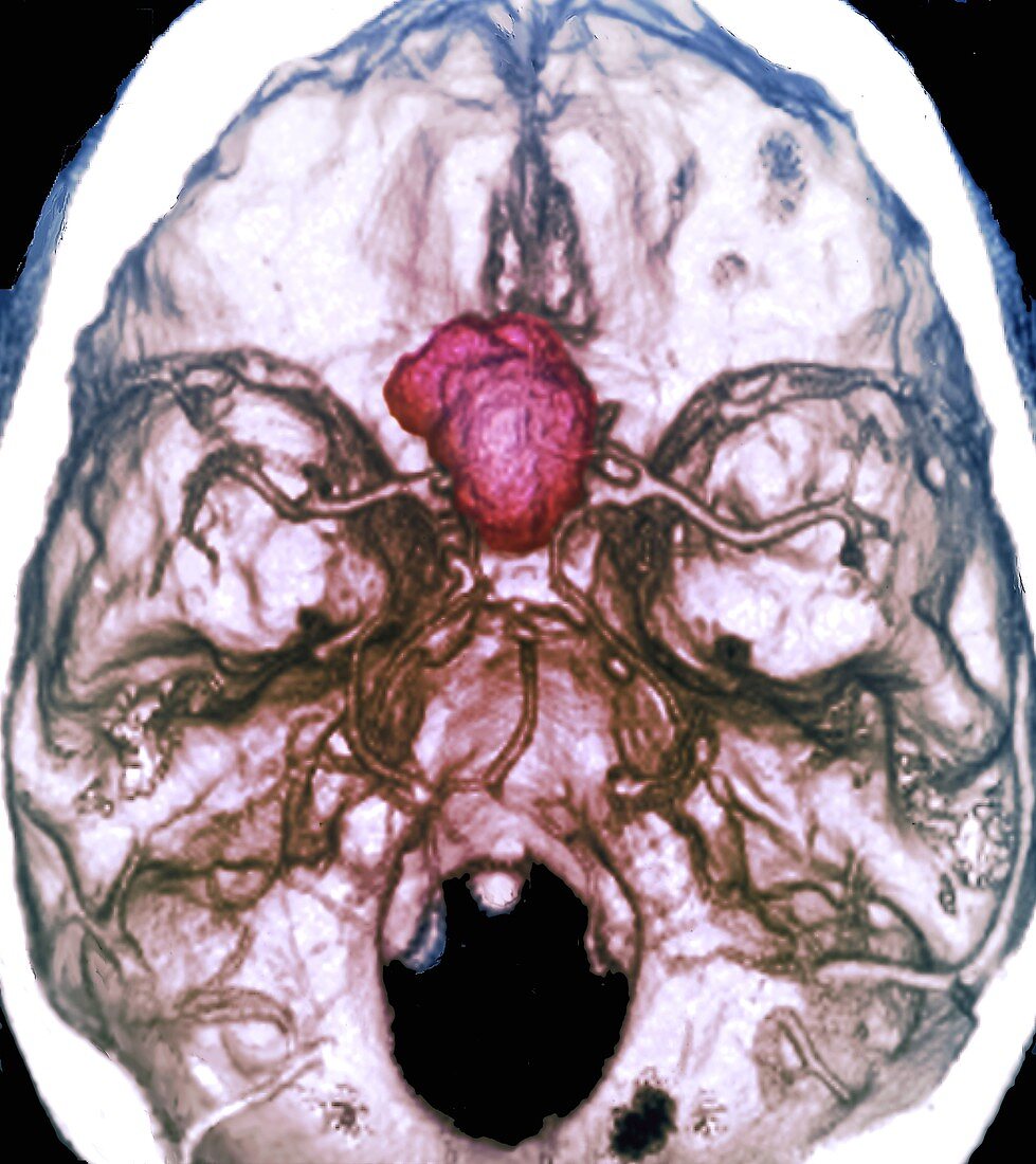 Meningioma brain cancer, CT scan