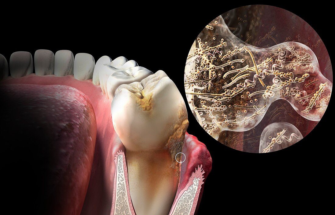 Plaque formation on teeth, illustration