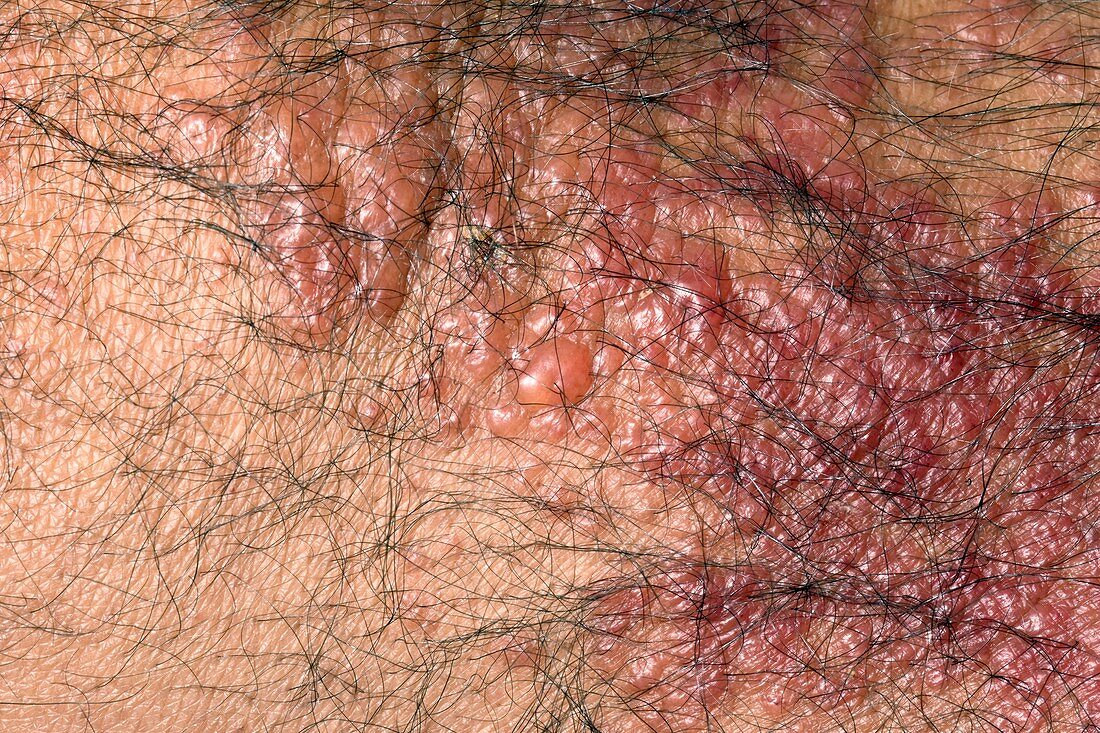 Eczema on the skin after surgery