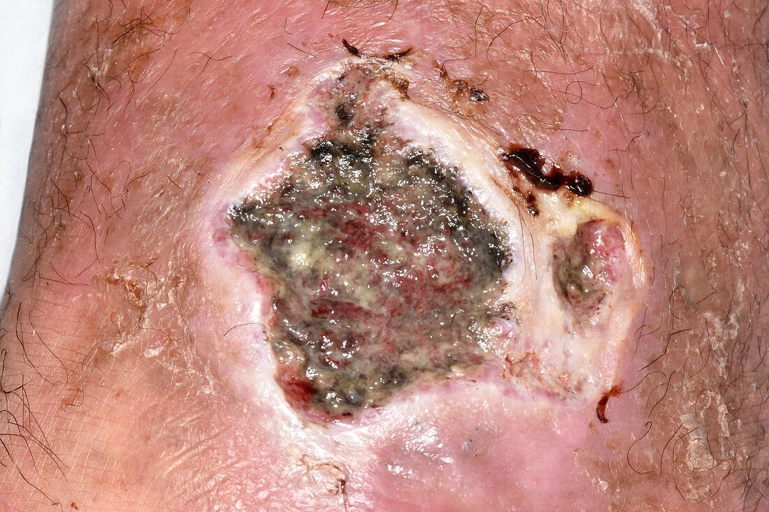 Infected leg ulcer