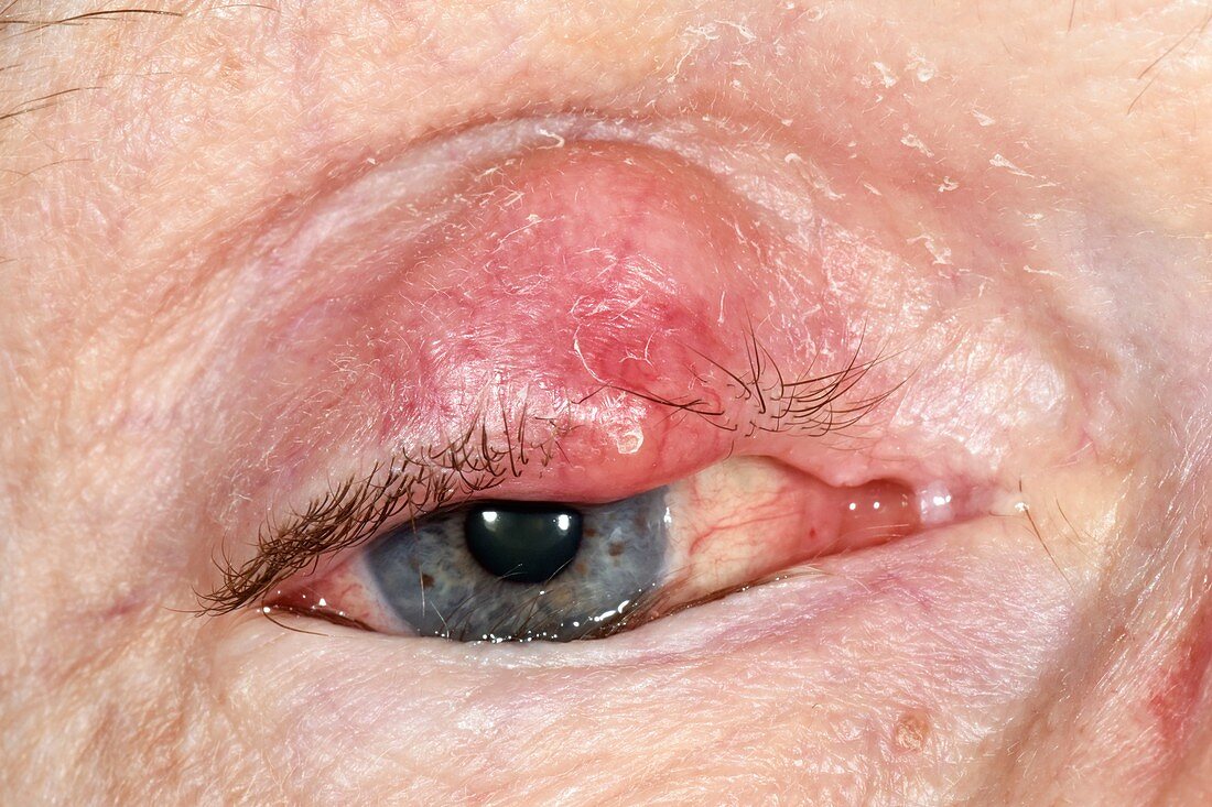 Chalazion abscess on an eyelid